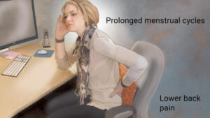 obesity and overweight in siddha medicine for fibroids in uterus