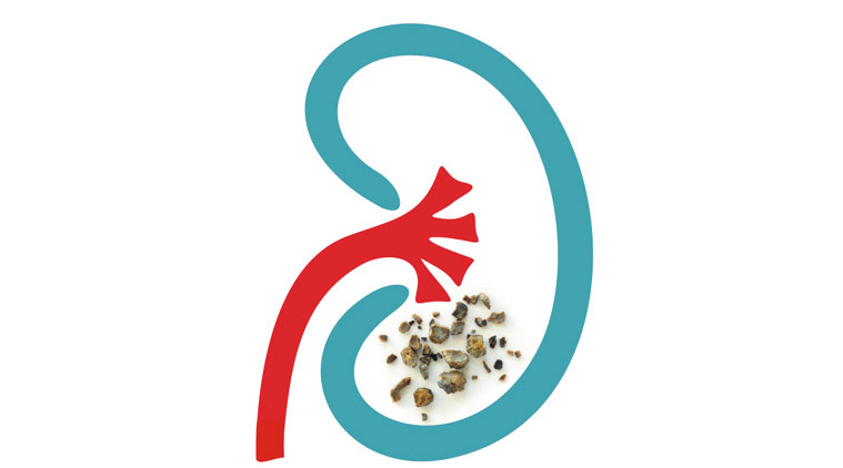 kidney stone siddha medicine